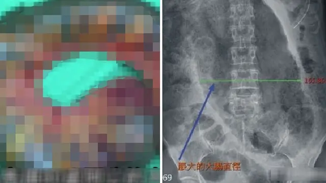 Seminggu Tidak BAB, Usus Lansia Terpaksa Dipotong Karena Penuh Kotoran