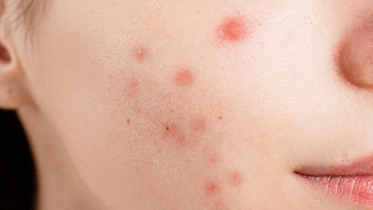 Doa Menghilangkan Jerawat dan Bisul, Acne Fighter Wajib Tahu!