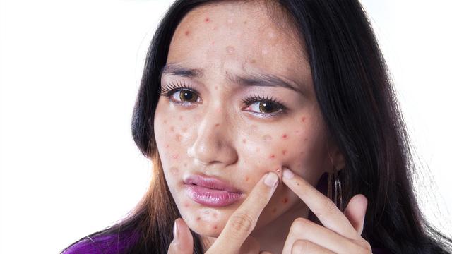 Cara Menghilangkan Bopeng Bekas Jerawat