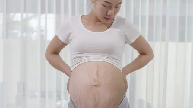 Tips Mengatasi Stretch Mark yang Sering Muncul di Masa Kehamilan, Kembalikan Percaya Diri dengan Perawatan yang Tepat