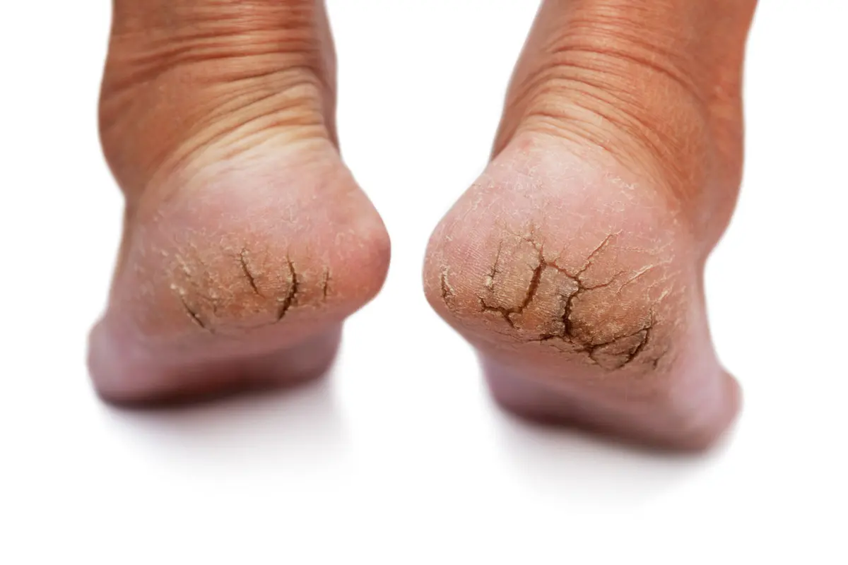 Cara Merawat Kaki Pecah-pecah