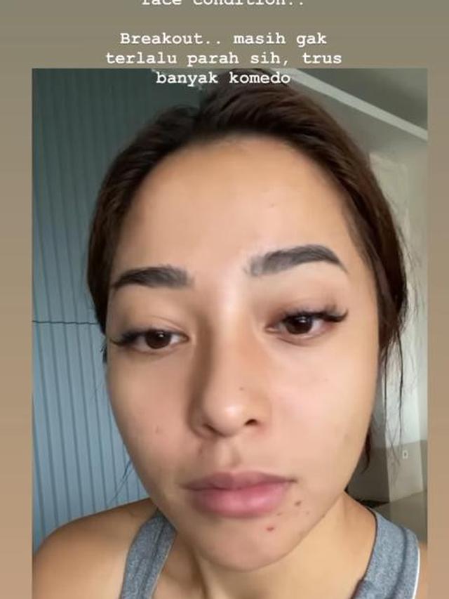 Unggah Foto Berjerawat, Ini 6 Potret Nikita Willy Tampil Natural
