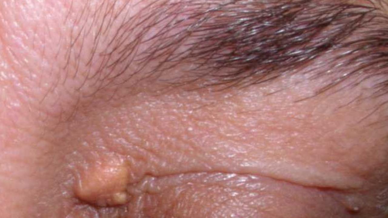 <b>5. Timbul Xanthoma</b>