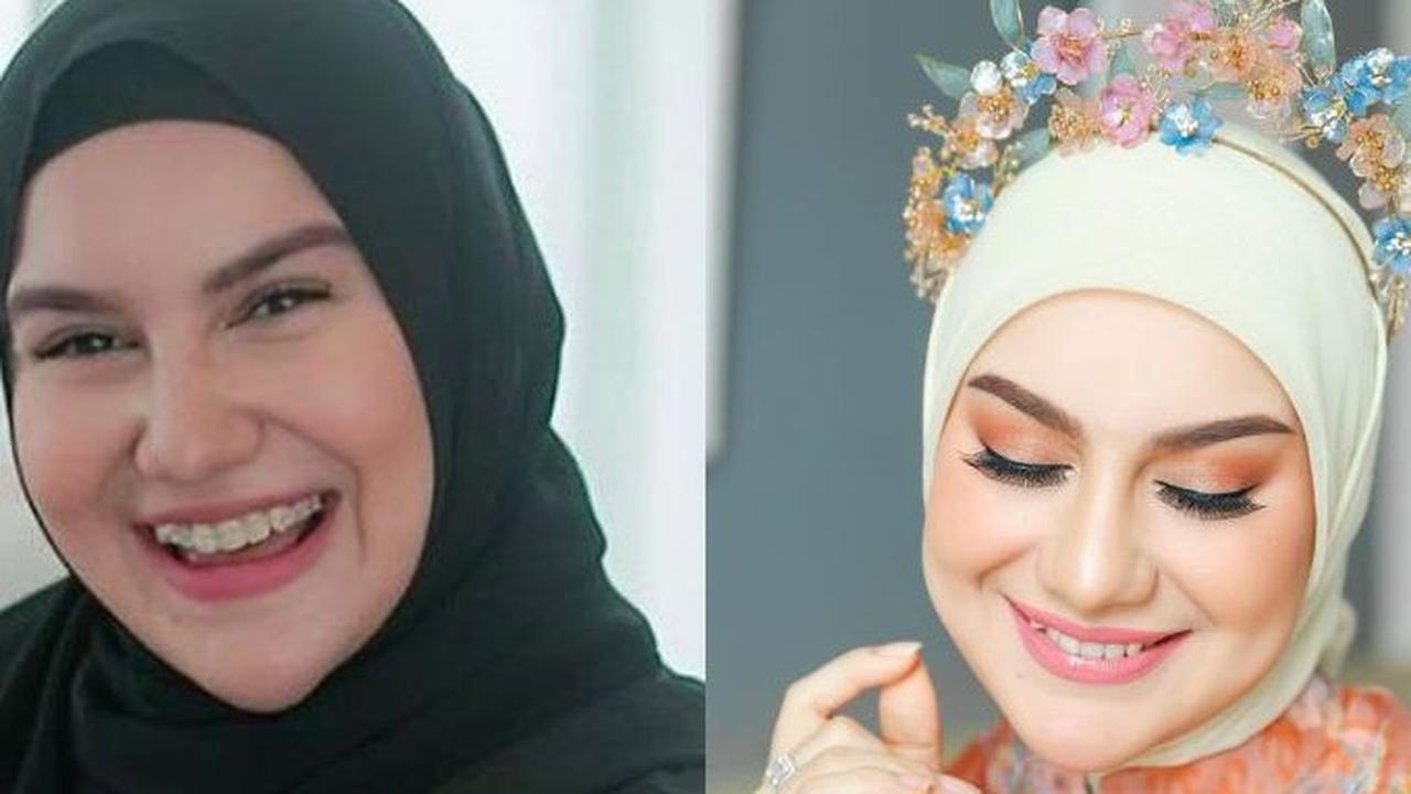Irish Bella memilih untuk merapikan gigi gingsulnya dengan menggunakan kawat gigi atau behel demi meningkatkan kepercayaan dirinya.&nbsp;