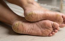 7 Cara Mengatasi Tumit Pecah-Pecah dengan Perawatan Rumahan, Kaki Kasar Jadi Lebih Halus