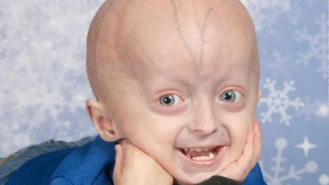 Progeria 
