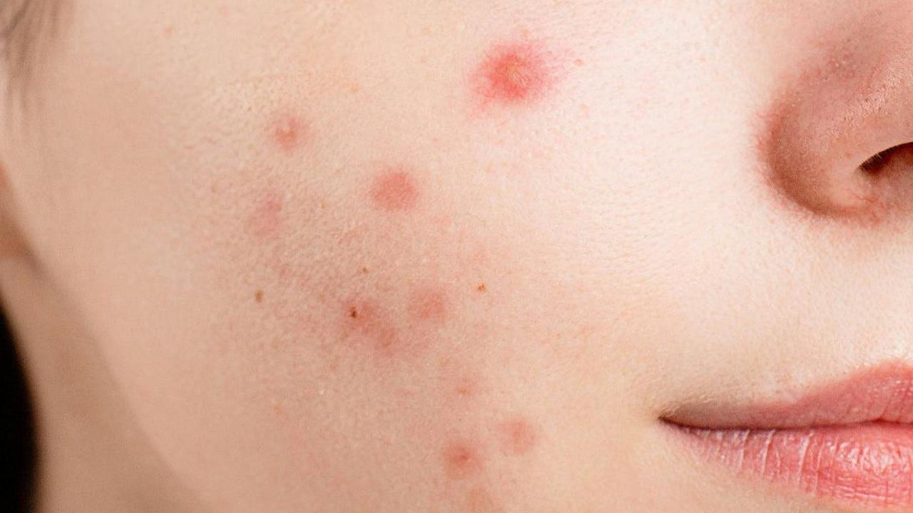 Waspada! Sering Bisulan Bisa Jadi Gejala Berbagai Penyakit Ini