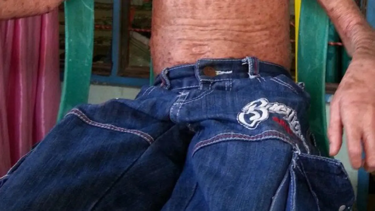 Alami Kelainan, Kulit Bocah 10 Tahun Ini Tak Bisa Berkeringat