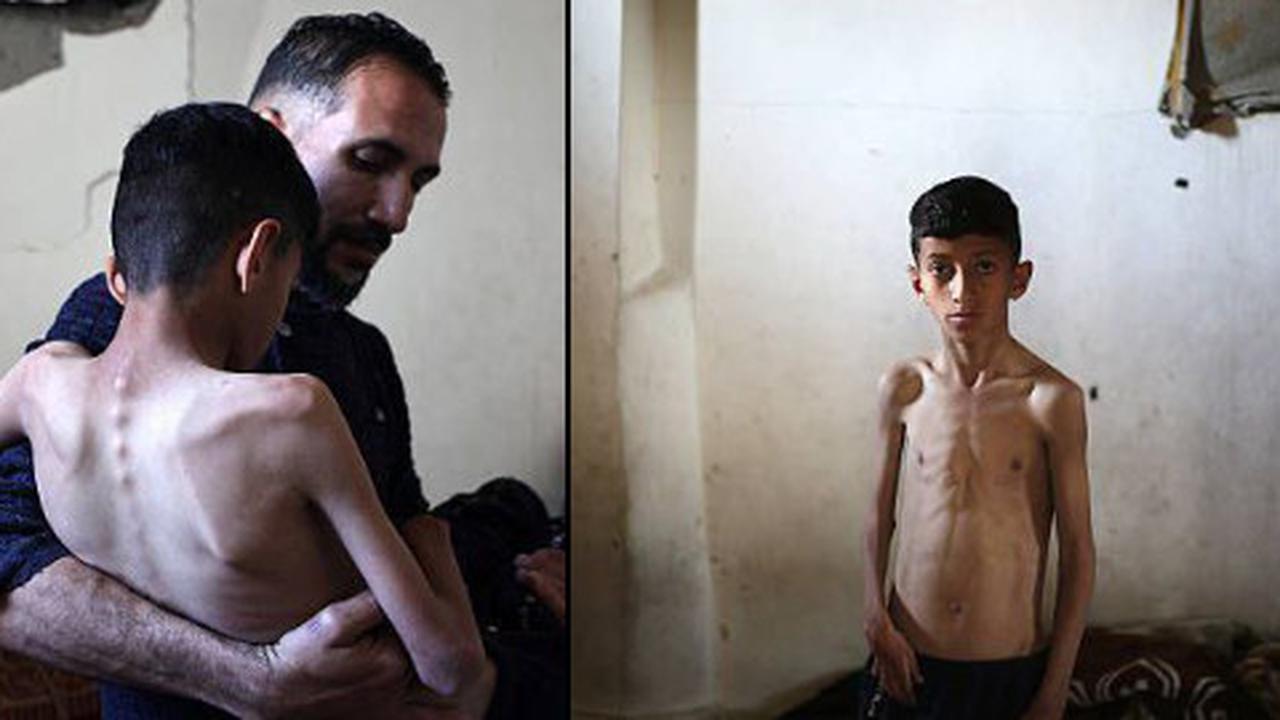 Potret Miris Anak-Anak Palestina di Gaza 'Tinggal Tulang' Akibat Kelaparan yang Diciptakan Israel