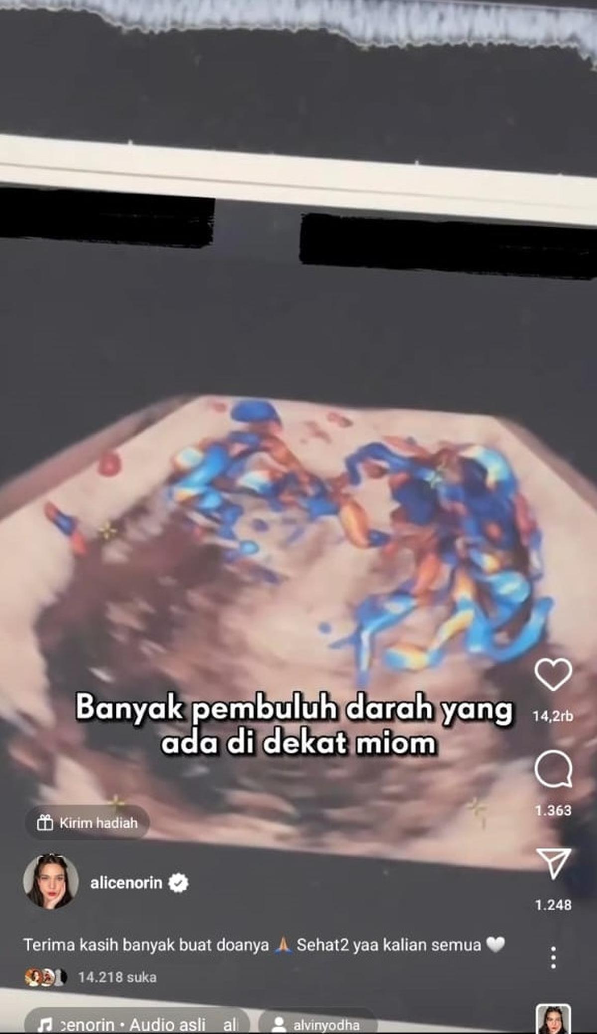 Alice kemudian diperiksa oleh dokter Fetomaternal dan ditemukan ada banyak pembuluh darah di miom tersebut.