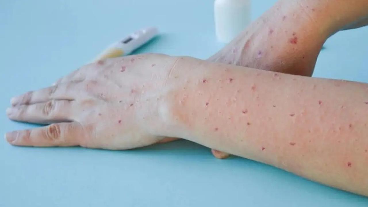 Waspada Penyakit Menular Cacar Api Bisa Sebabkan Kebutaan, Banyak Menyerang Usia 45-64 Tahun