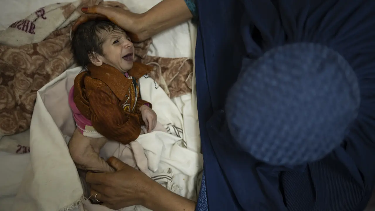Gizi Buruk Ancam Anak-anak di Afghanistan