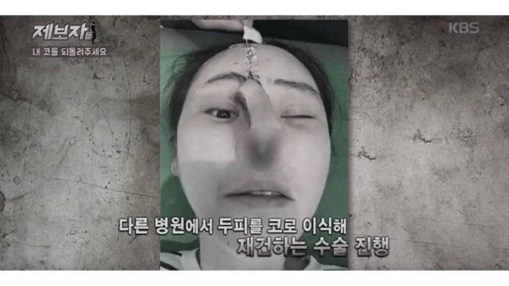 Operasi Hidung yang Gagal. (Foto: Allkpop)