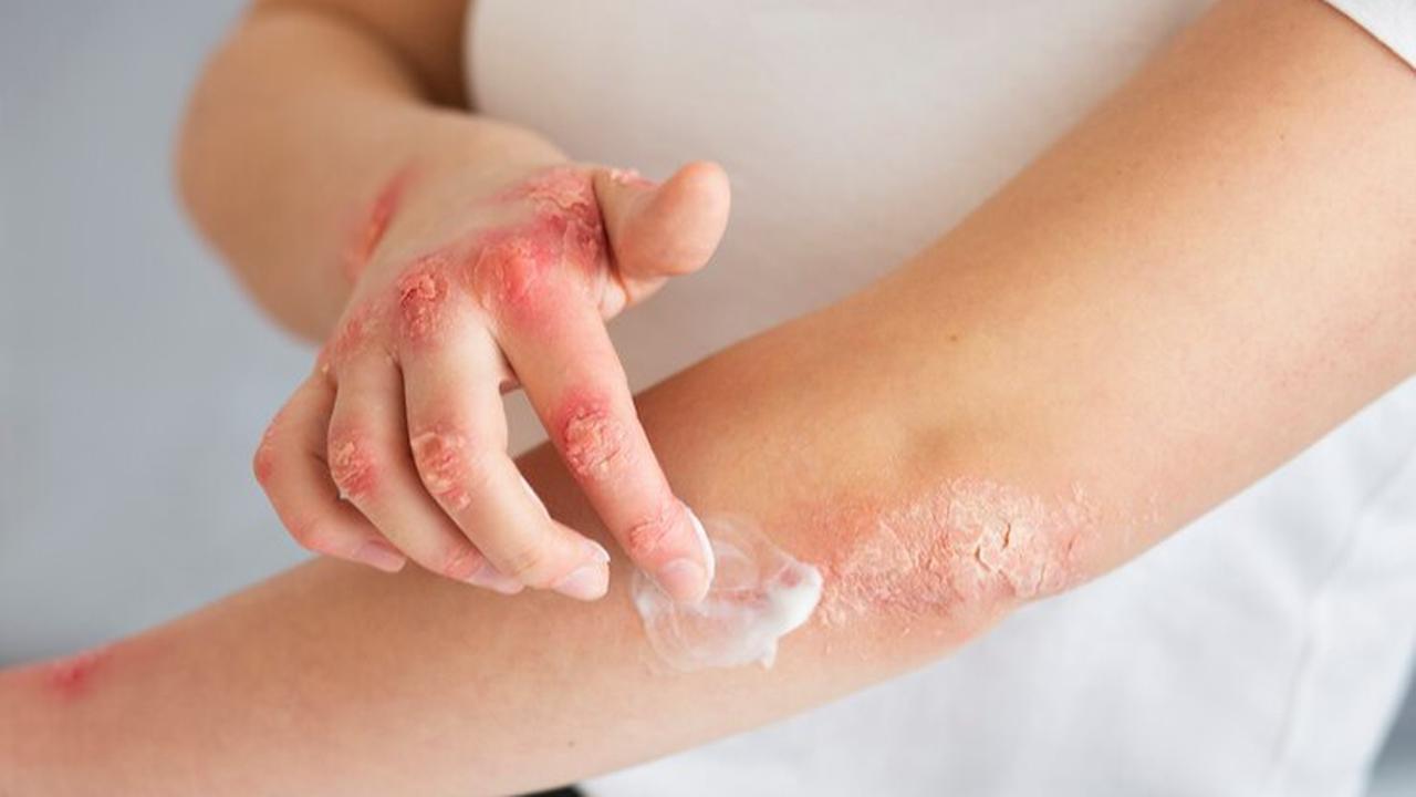 eczema