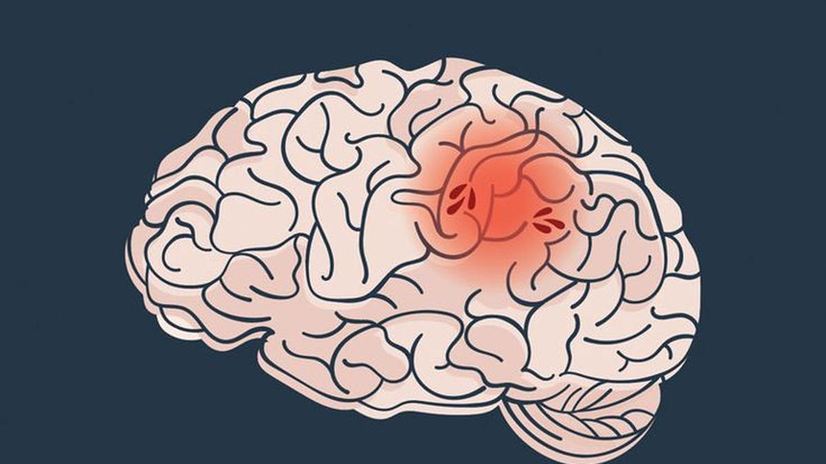 5 Tips Mencegah Stroke dengan Gaya Hidup Sehat dan Aktif