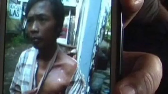 Gumpalan Kain Kasa di Bekas Luka Operasi