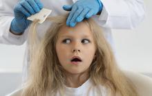 10 Cara Sederhana Menghilangkan Kutu Rambut dan Telurnya Secara Alami dan Permanen