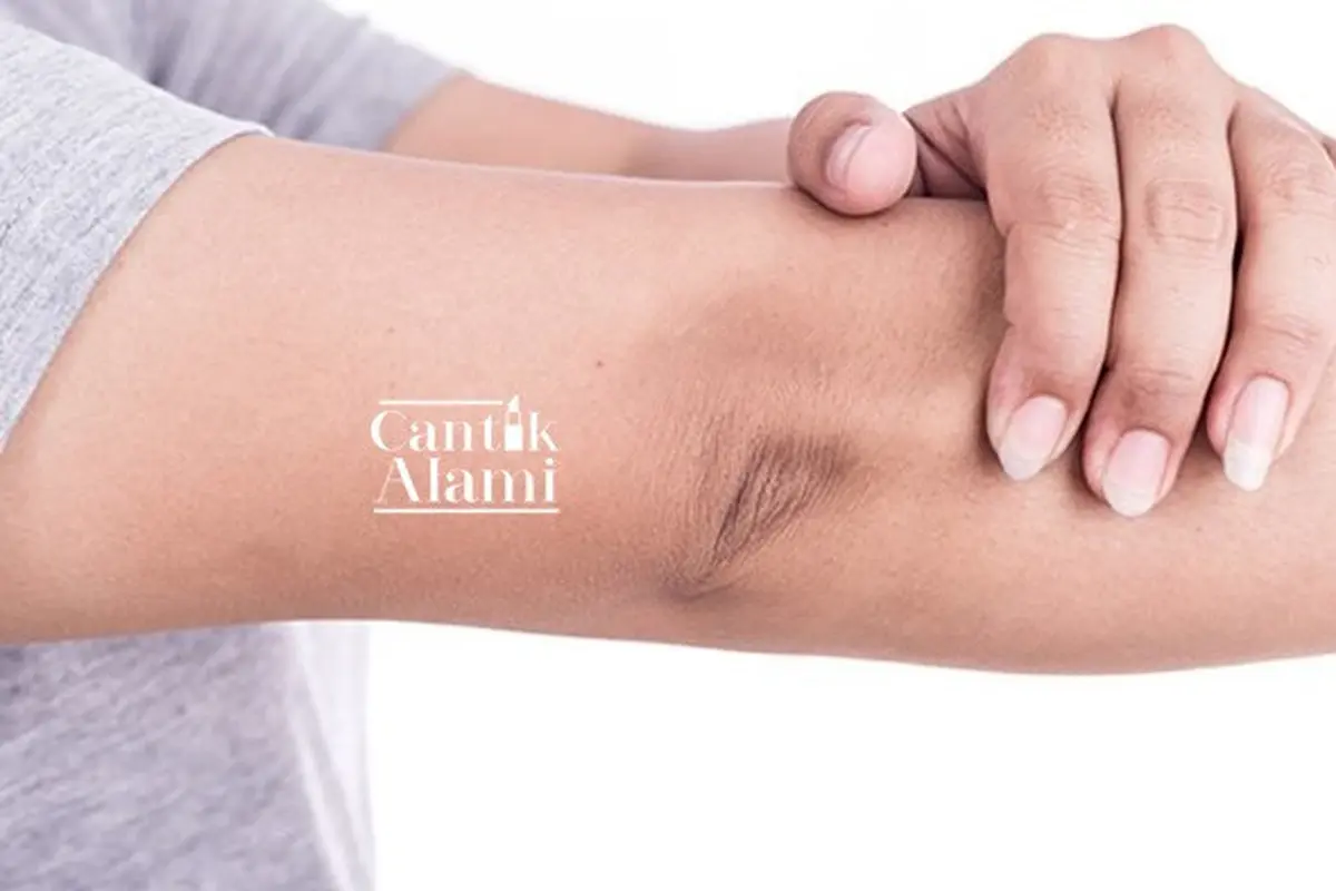 Cantik Alami: Siku Hitam Bikin Nggak Pede? Begini Cara Mencerahkannya