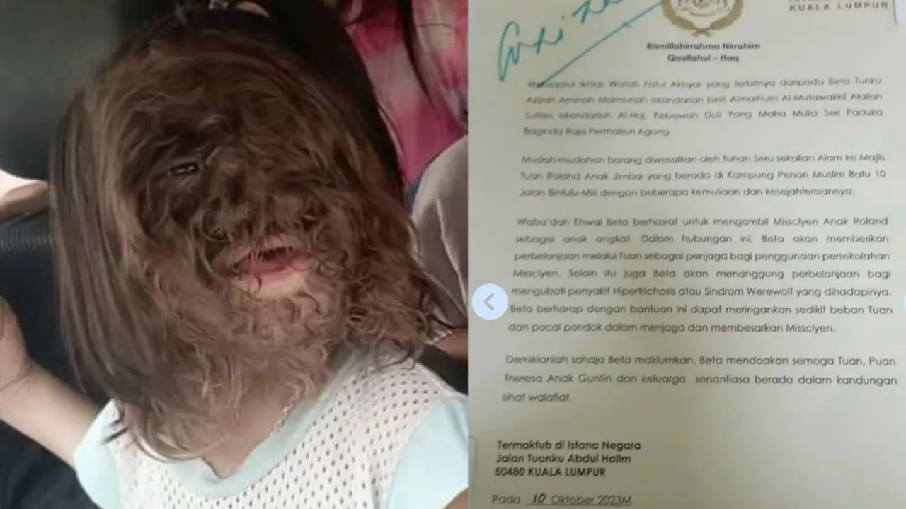 Ratu Malaysia mengadopsi seorang anak dengan sindrom manusia serigala