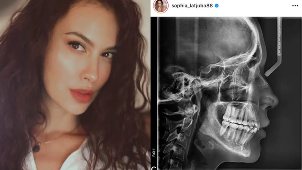 Hasil rontgen Sophia Latjuba