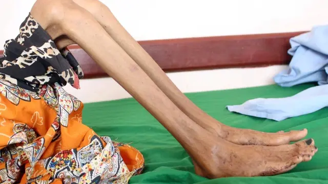 Kisah Pilu Gadis Malnutrisi Korban Perang
