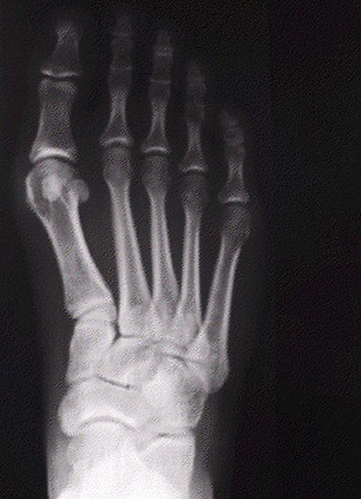 bunion