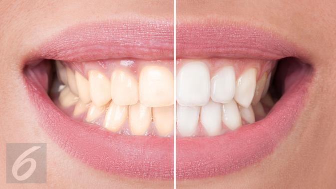 6 Jenis Gigi Ini Tak Boleh Pasang Veneer Simak Penjelasan Pakar