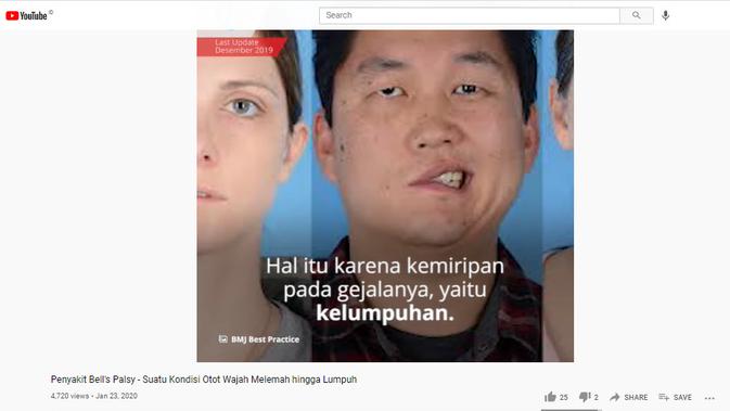 Cek Fakta Liputan6.com menelusuri klaim foto orang mengalami kelumpuhan wajah setelah divaksin corona