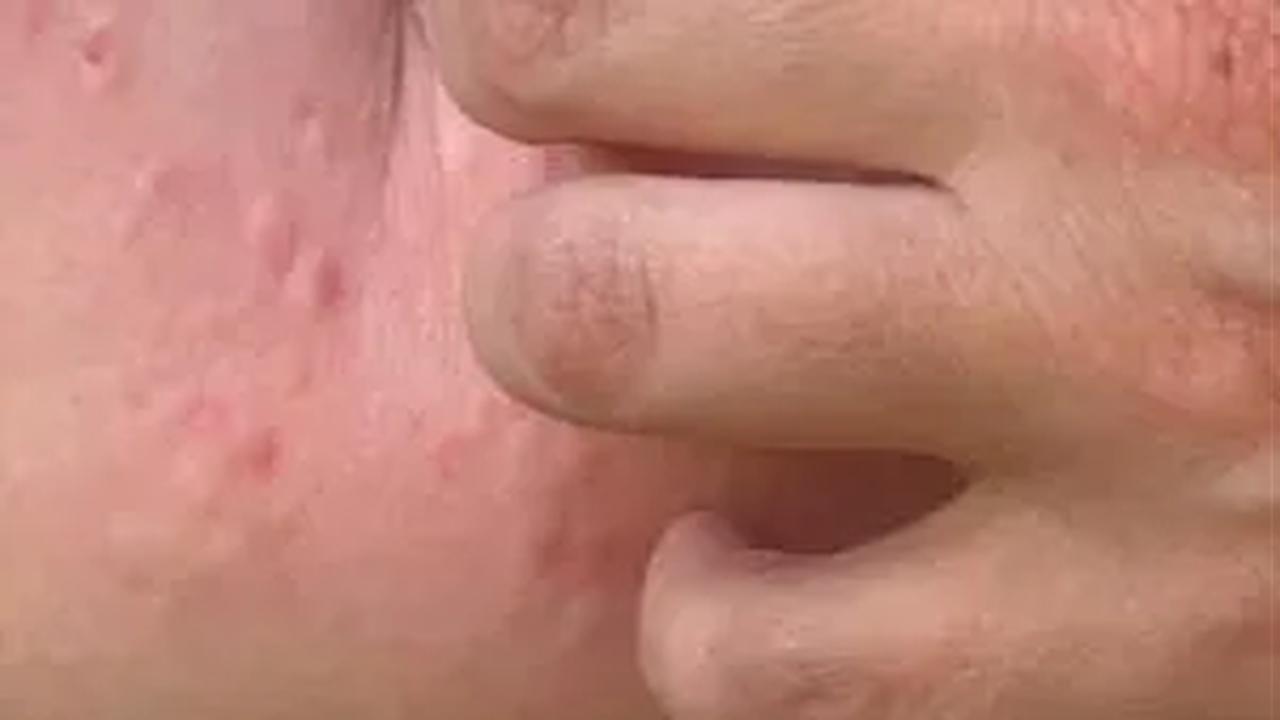 Penyebab Kasus Cacar Monyet Meningkat<br>