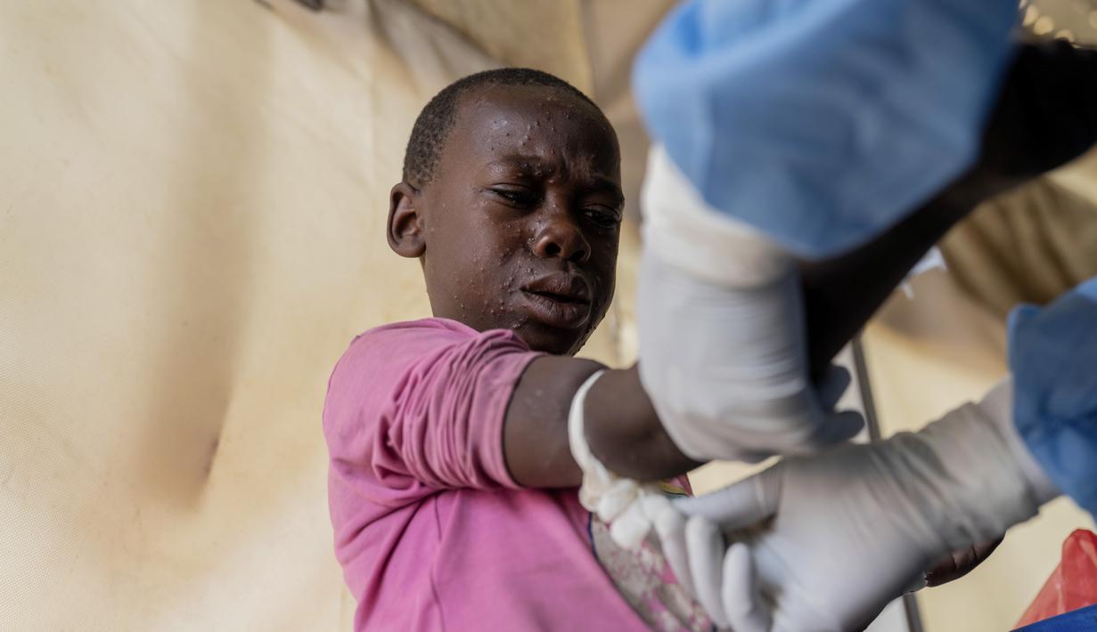 Anak-anak di bawah 15 tahun menyumbang lebih dari 70 persen kasus dan 85 persen kematian di Kongo. (AP Photo/Moses Sawasawa)