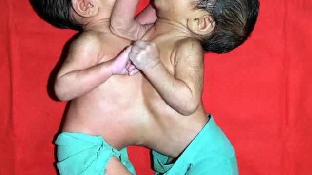 Kisah Bocah Kembar Siam yang Terpisah Setelah 12 Jam Dioperasi Ini Viral