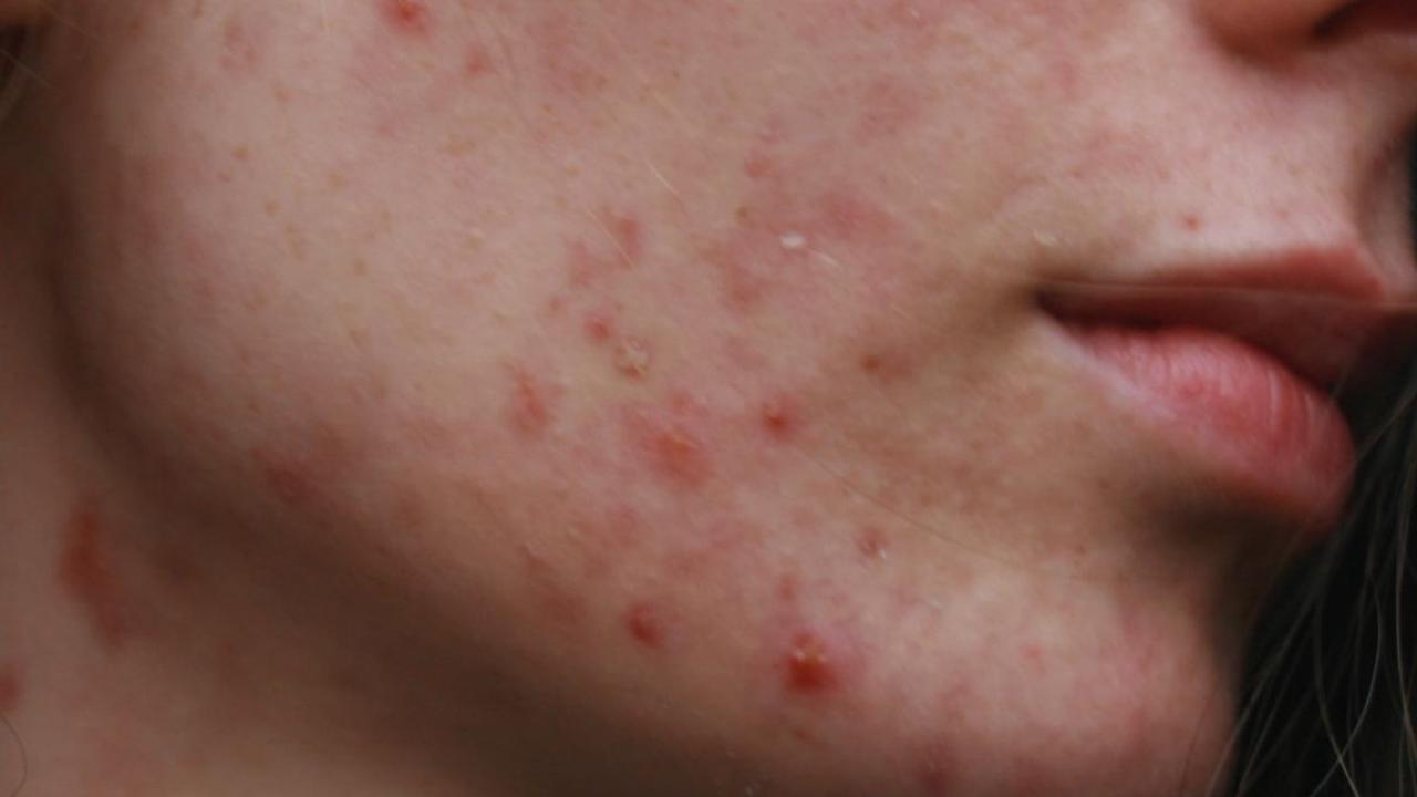<b>2. Inflammatory Spots</b><br>
