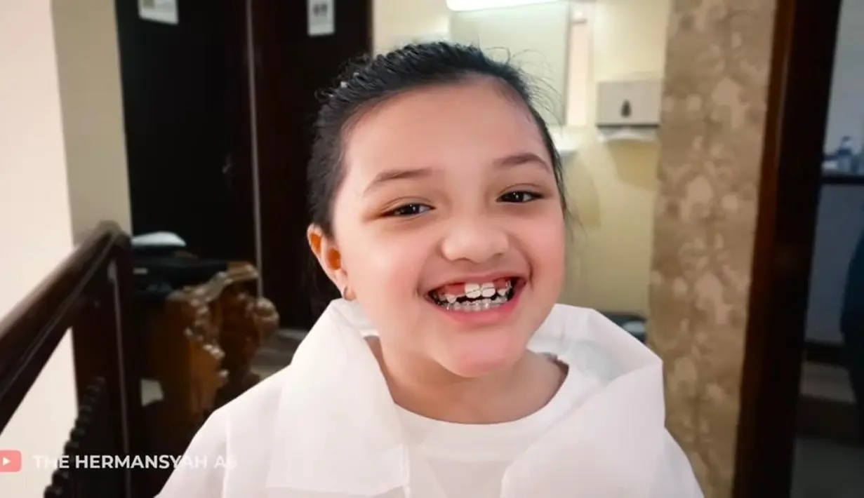 Jika usia Arsy sudah menginjak 9 tahun, barulah dia bisa pakai jenis kawat gigi permanen. Kecantikannya pun bertambah kala ia pakai behel. (YouTube/The Hermansyah A6).