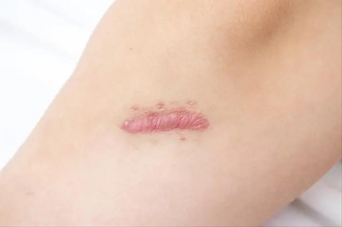 Mengungkap Keloid, Penyebab dan Cara Efektif Mencegahnya