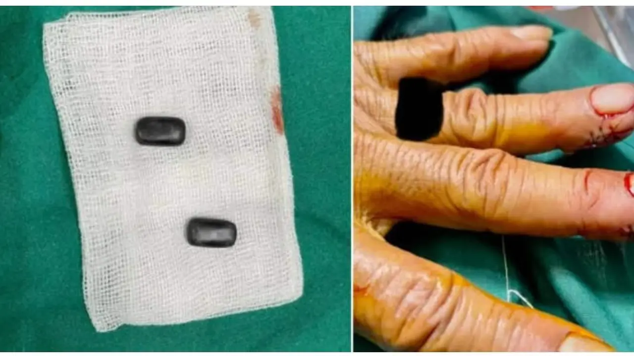 Tangan pasien yang di operasi untuk mengeluarkan magnet di dalamnya (Tangkapan layar dari website odditycentral.com)