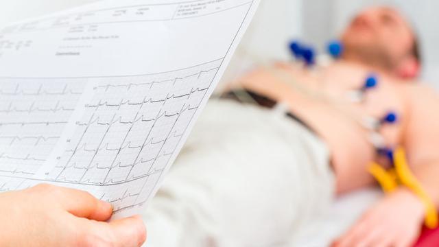 4 Penyebab Tersering Stroke di Usia Muda