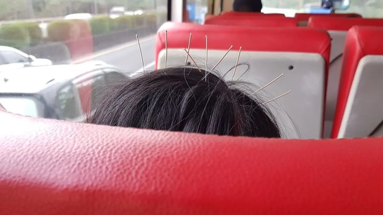Bikin Heboh, Wanita Ini Naik Bus dengan 9 Jarum Akupuntur Tertusuk di Kepala