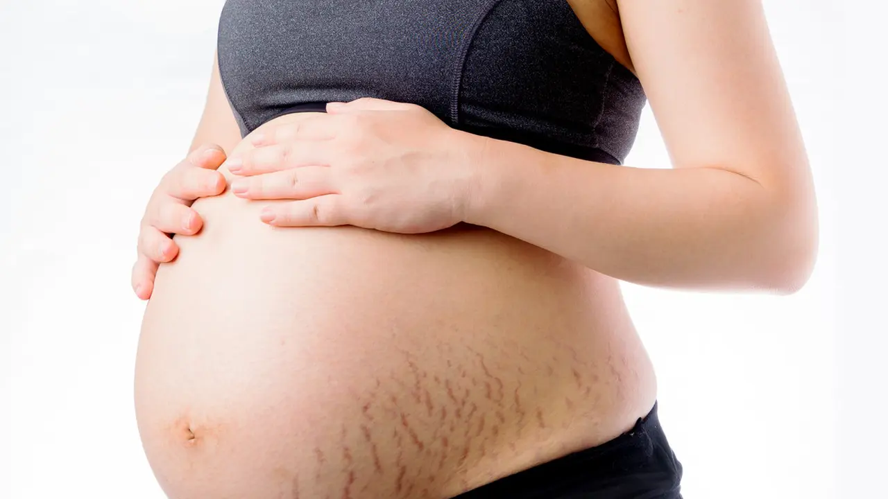 Stretch Marks