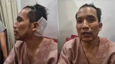Desta Jalani Transplantasi Rambut (Foto: Instagram/ dr_tompi)