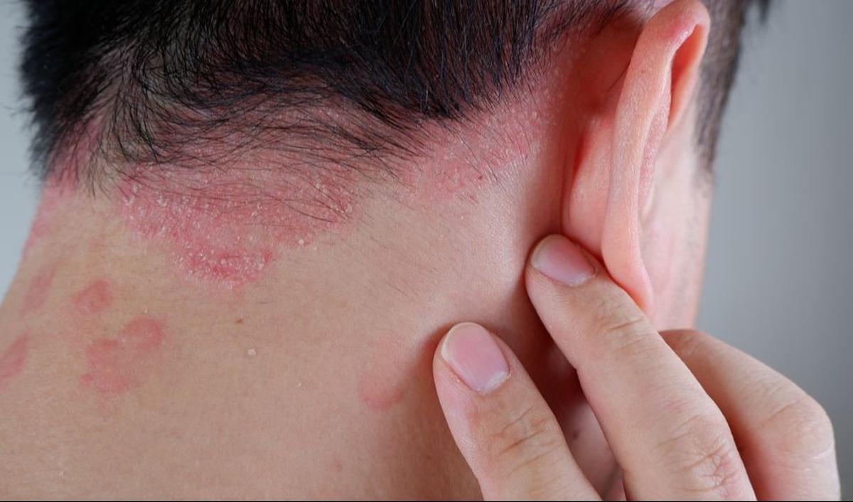 <b>6. Psoriasis </b>