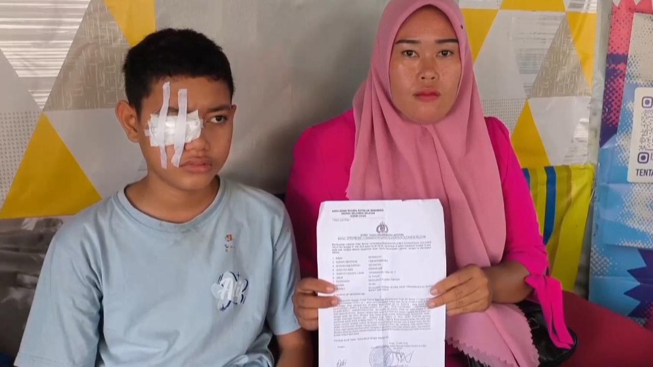 Kronologi Mata Siswa SMP di Gowa Dikatapel Pakai Tusuk Bakso hingga Buta, Sudah Lapor Polisi Tapi Mandek