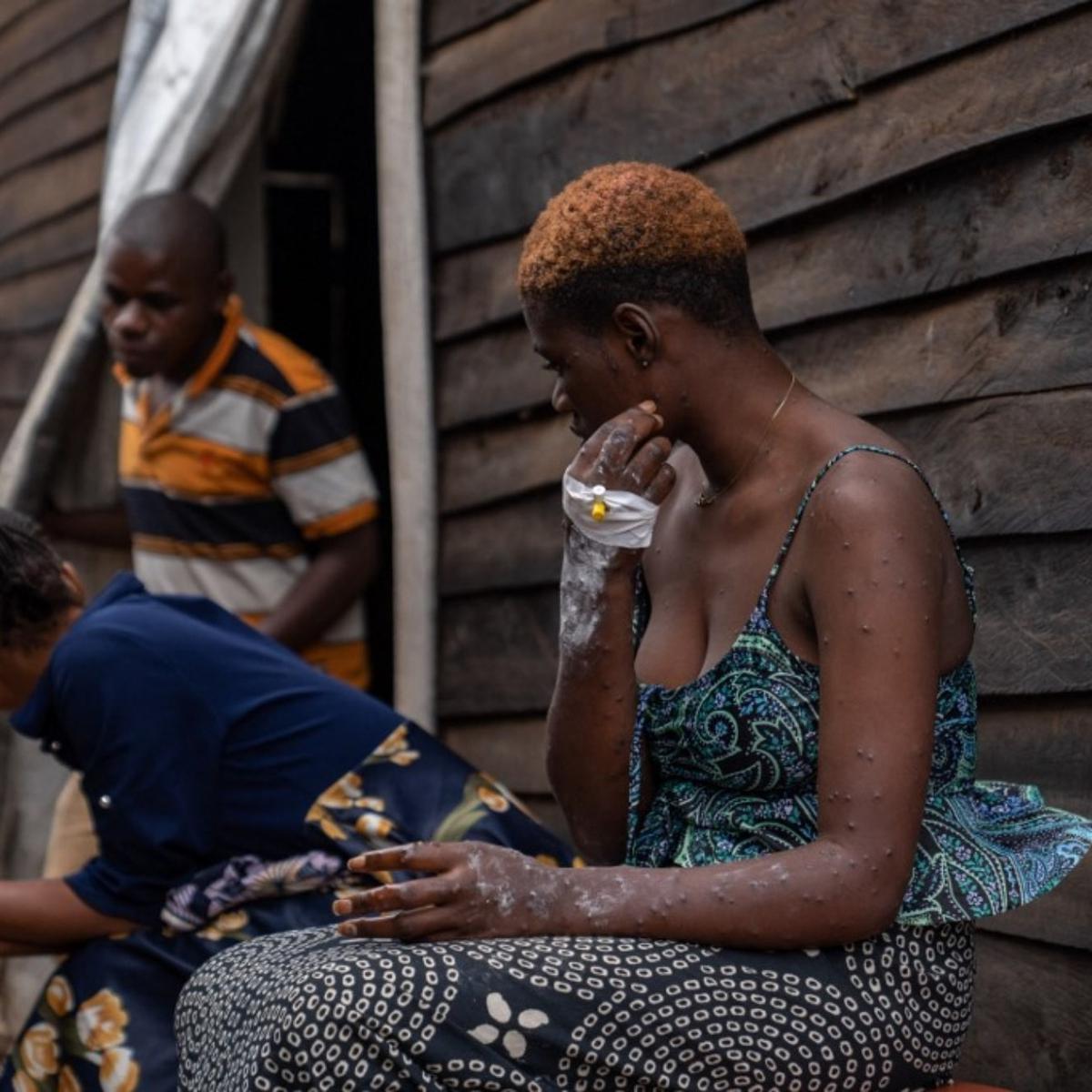 Wabah Mpox atau Cacar Monyet di Burundi