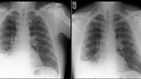 Perbedaan paru-paru pasien asal Inggris setelah kerucut mainan lalu lintas dari Playmobil di angkat oleh dokter (BMJ)