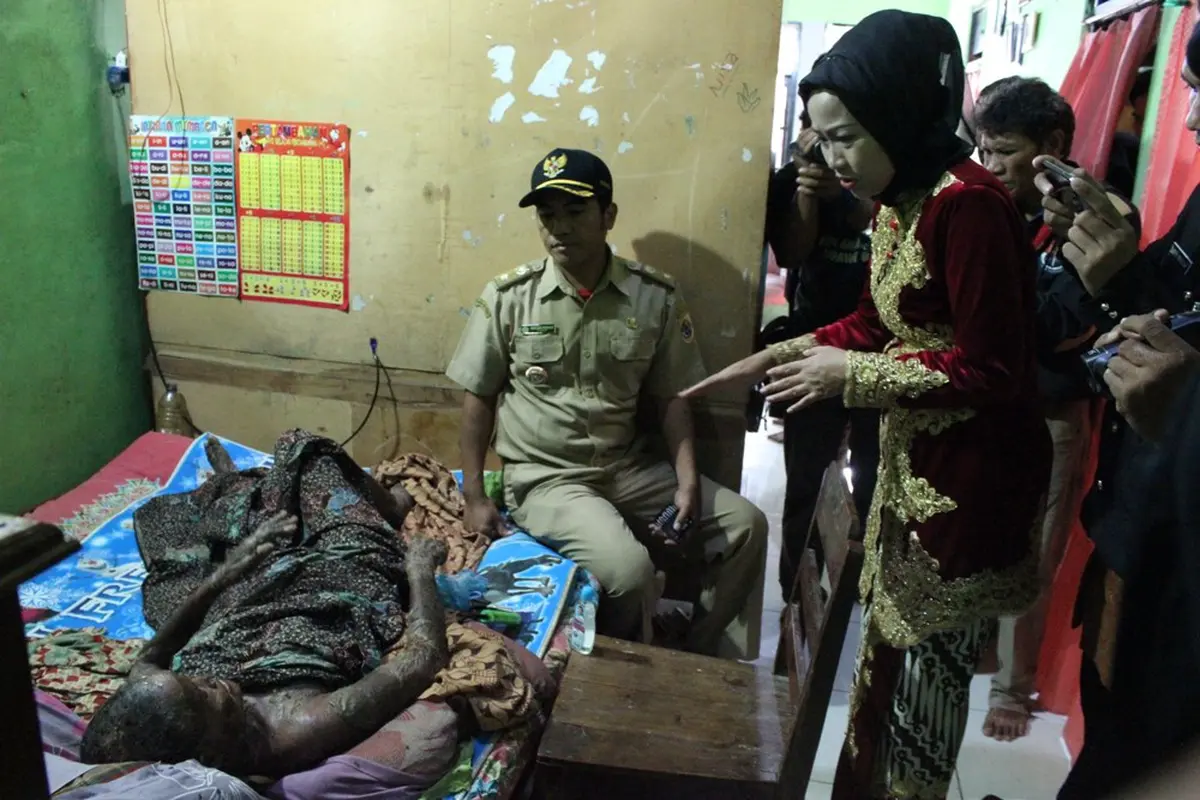 Kulit Melepuh Sekujur Tubuh, Kasturi Diduga Akibat Alergi Obat