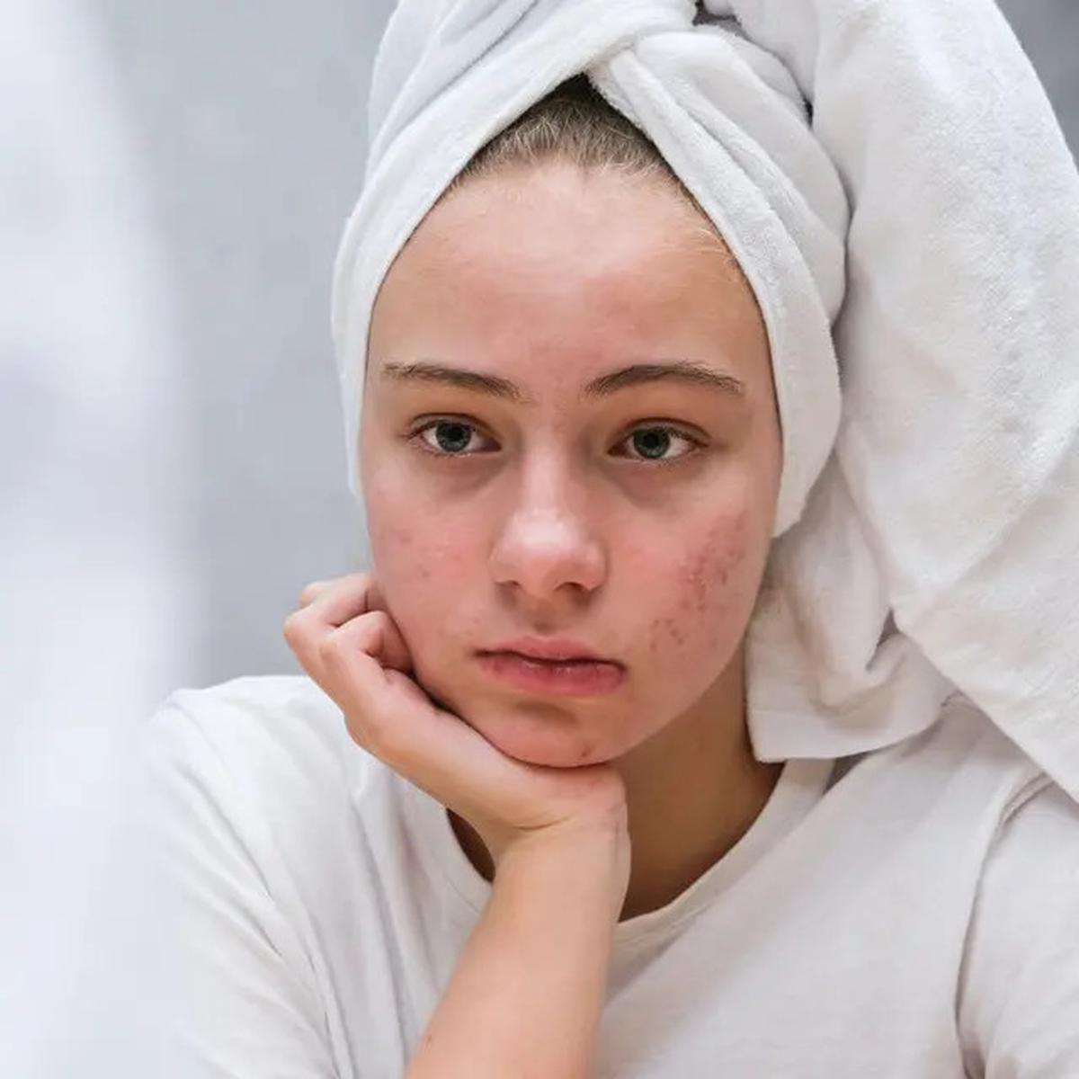 Ini Bedanya Muka Berminyak dan Muka Lembap, Jangan Salah Rawat