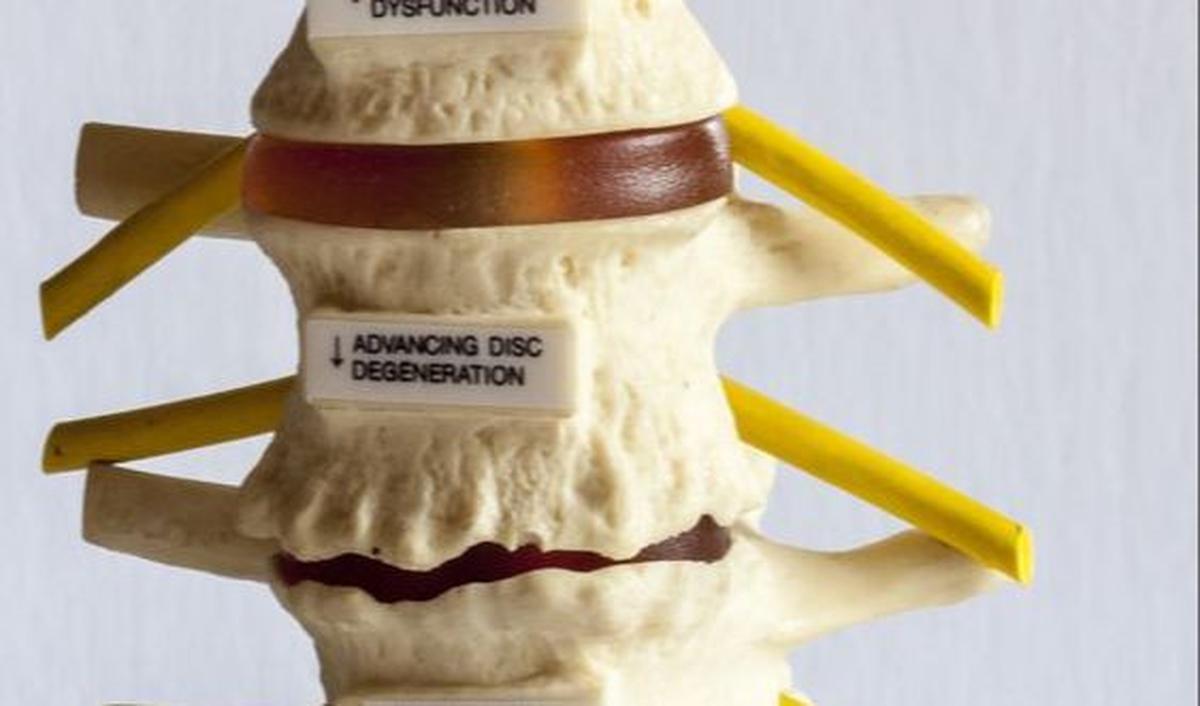 Spondylolisthesis