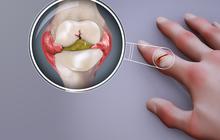 5 Penyebab Rematik Kambuh, Waspadai Makanan yang Memicunya
