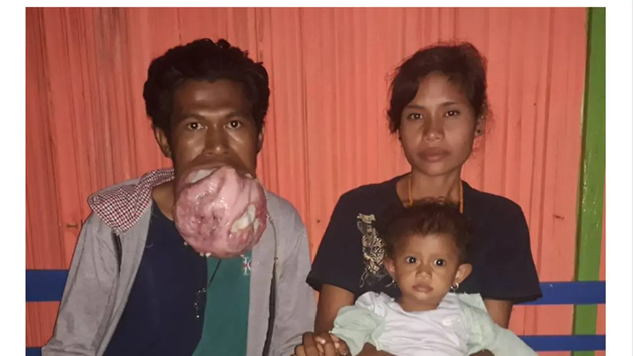 Pria penderita tumor ganas