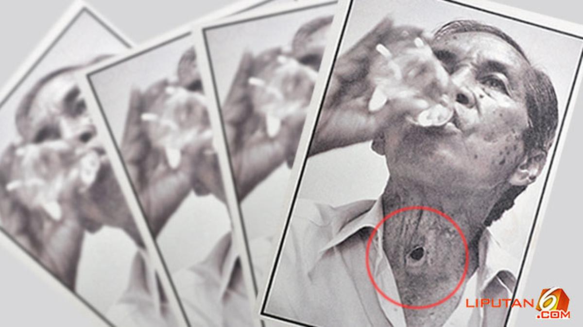 Seruan Korban Rokok: Jangan Mengurangi Tapi Berhenti Total - Health ...