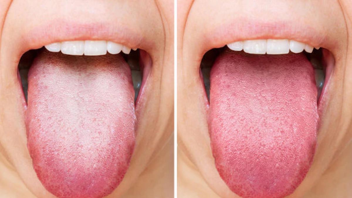 Warna Lidah Bisa Jadi Cermin Kesehatan Tubuh, Begini Cara Mengenalinya